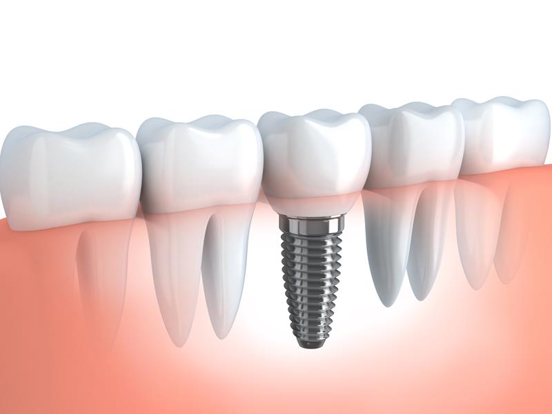 Dental Implants  Wolfeboro, NH 